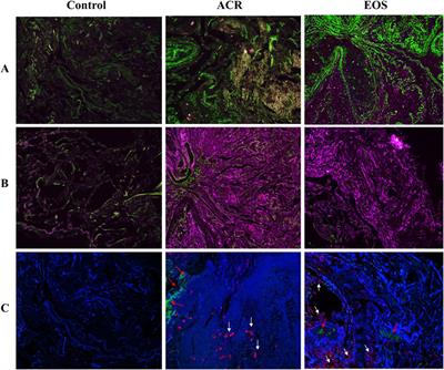 Proteomic Analysis of Transbronchial Biopsy Tissue Reveals a Distinct Proteome and Mechanistic Pathways in High-Grade Eosinophilic Inflammation After Lung Transplantation